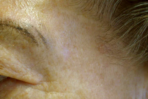 Na een fractional co2 laser behandeling Na een fractional co2 laser behandeling
