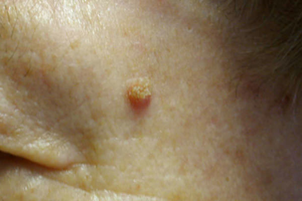 Voor een fractional co2 laser behandeling Voor een fractional co2 laser behandeling