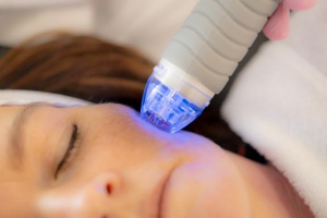 Microneedling met Radio Frequentie