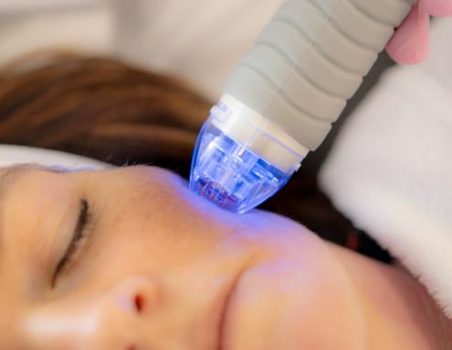 Microneedling met Radio Frequentie